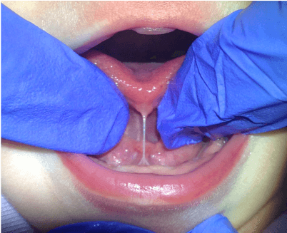 Anterior tongue tie example