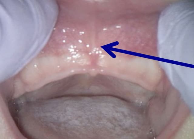 Labial frenum anatomy