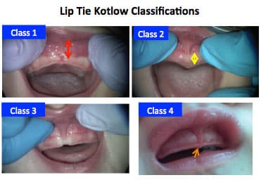 Lip tie classifications