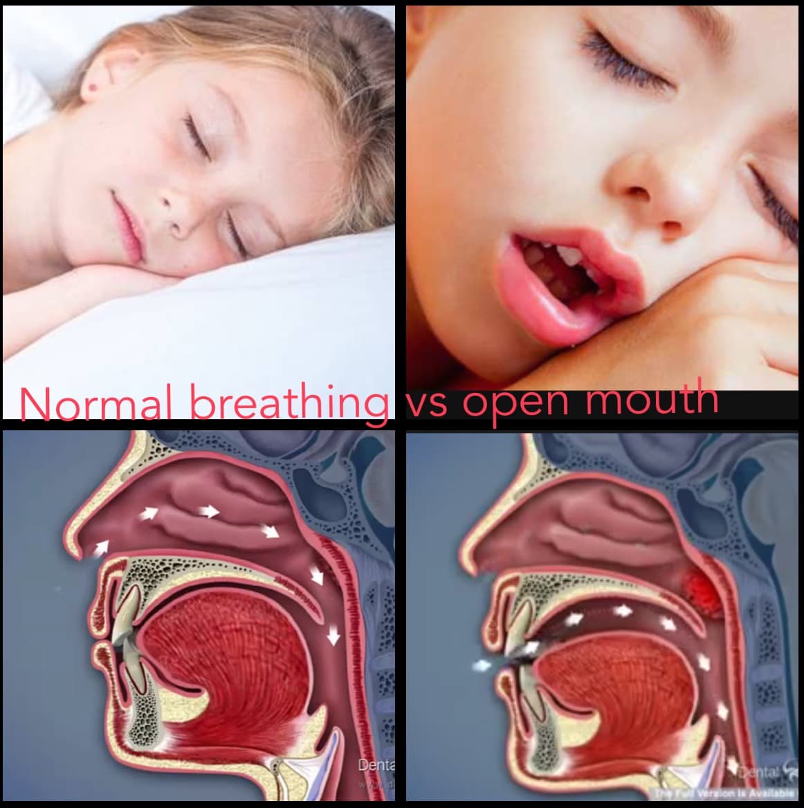 Nasal breathing vs mouth breathing comparison in children