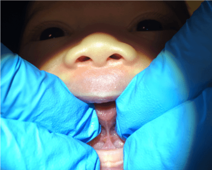 Posterior tongue tie example